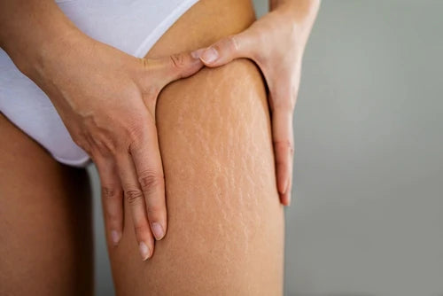Stretch Marks